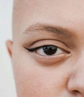 Alopecia Pestañas